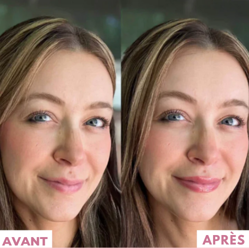 PillowLips ™ | Booster à Lèvres Microneedling