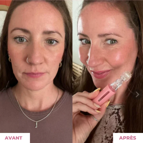 PillowLips ™ | Booster à Lèvres Microneedling