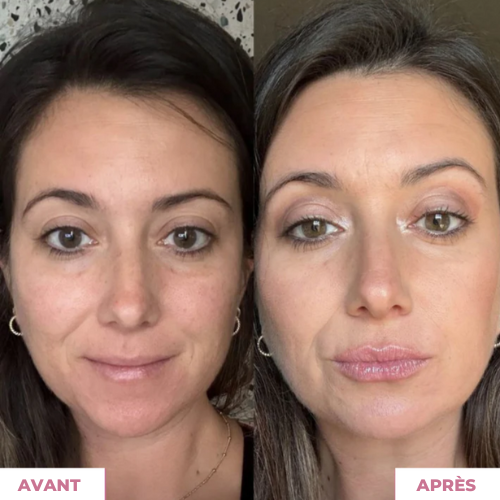 PillowLips ™ | Booster à Lèvres Microneedling