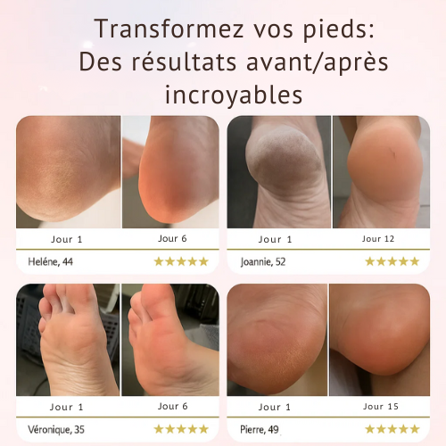 Calluvia™ | Adoucisseur de Pieds Électrique