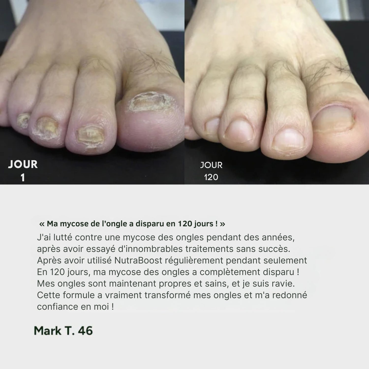 Nuvare | Gel traitant mycose des ongles