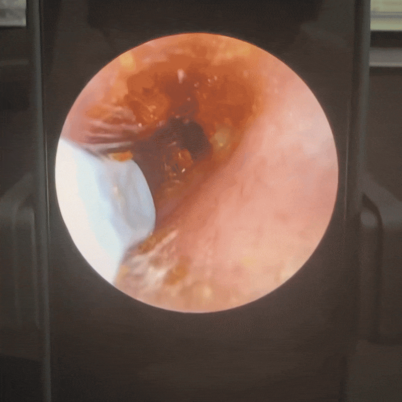 Nuvare | Nettoyeur d’oreilles intelligent