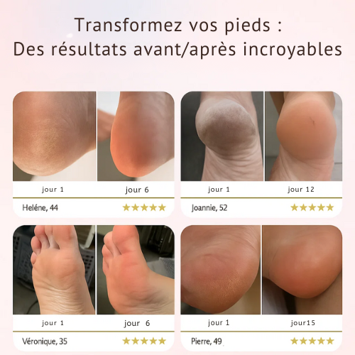 Pédivelle™ | Adoucisseur Électrique pour les Pieds