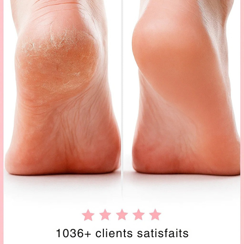Pédivelle™ | Adoucisseur Électrique pour les Pieds