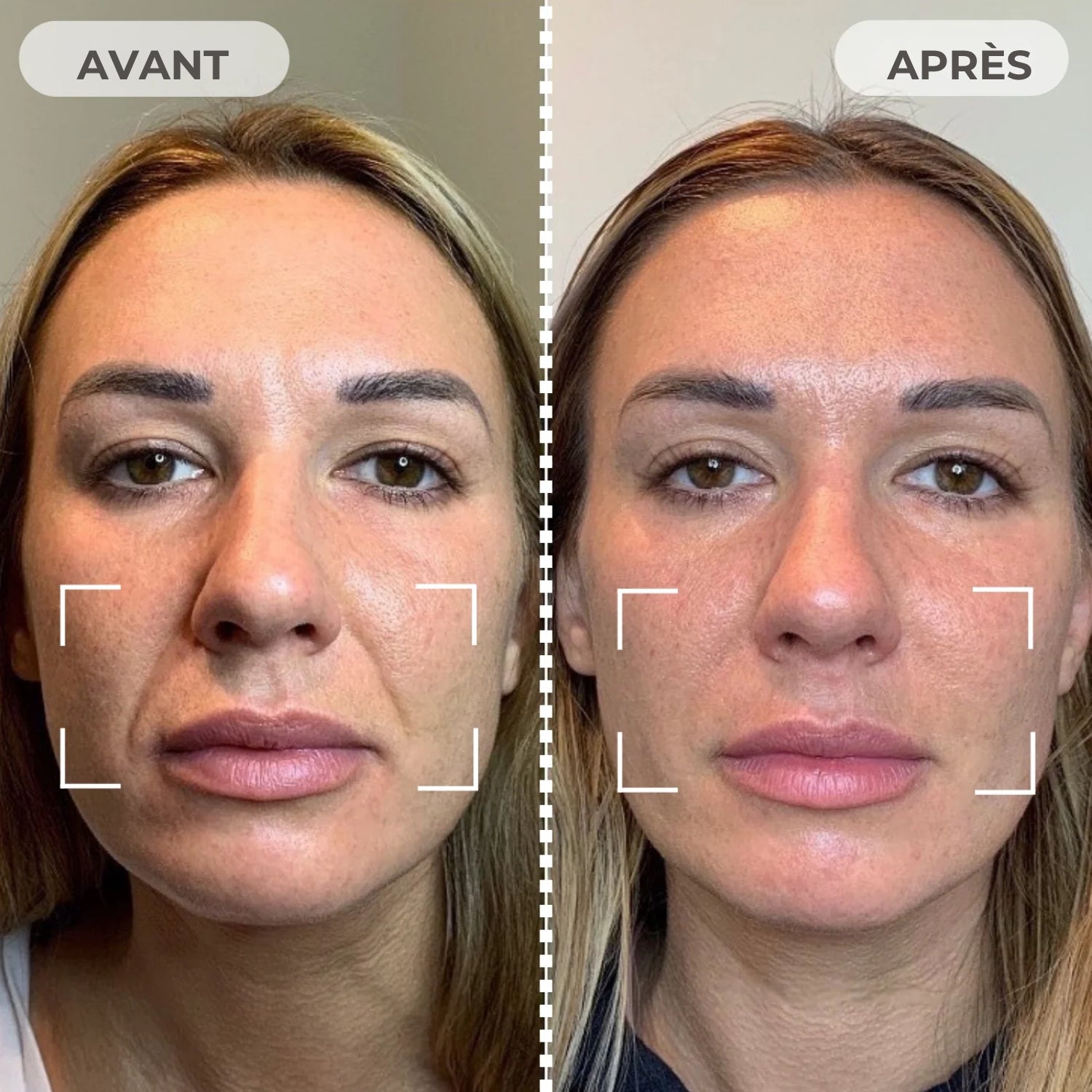 Nuvare™ | Pro-Grade EMS Masque