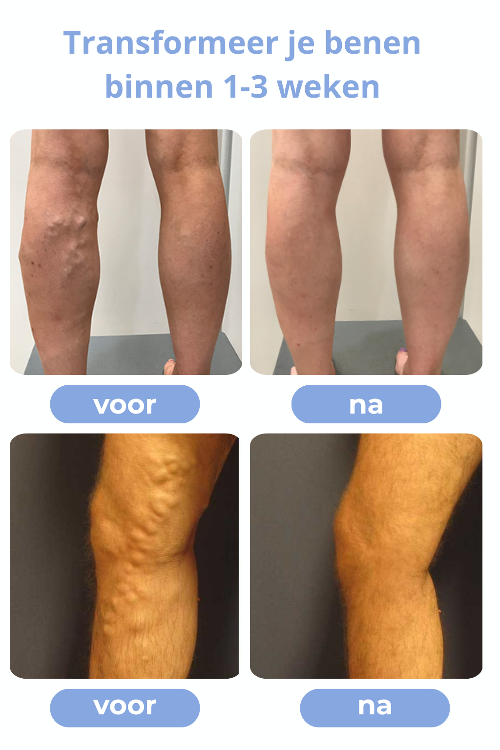 Séréniva™ | Spray Contre les Varices Visibles