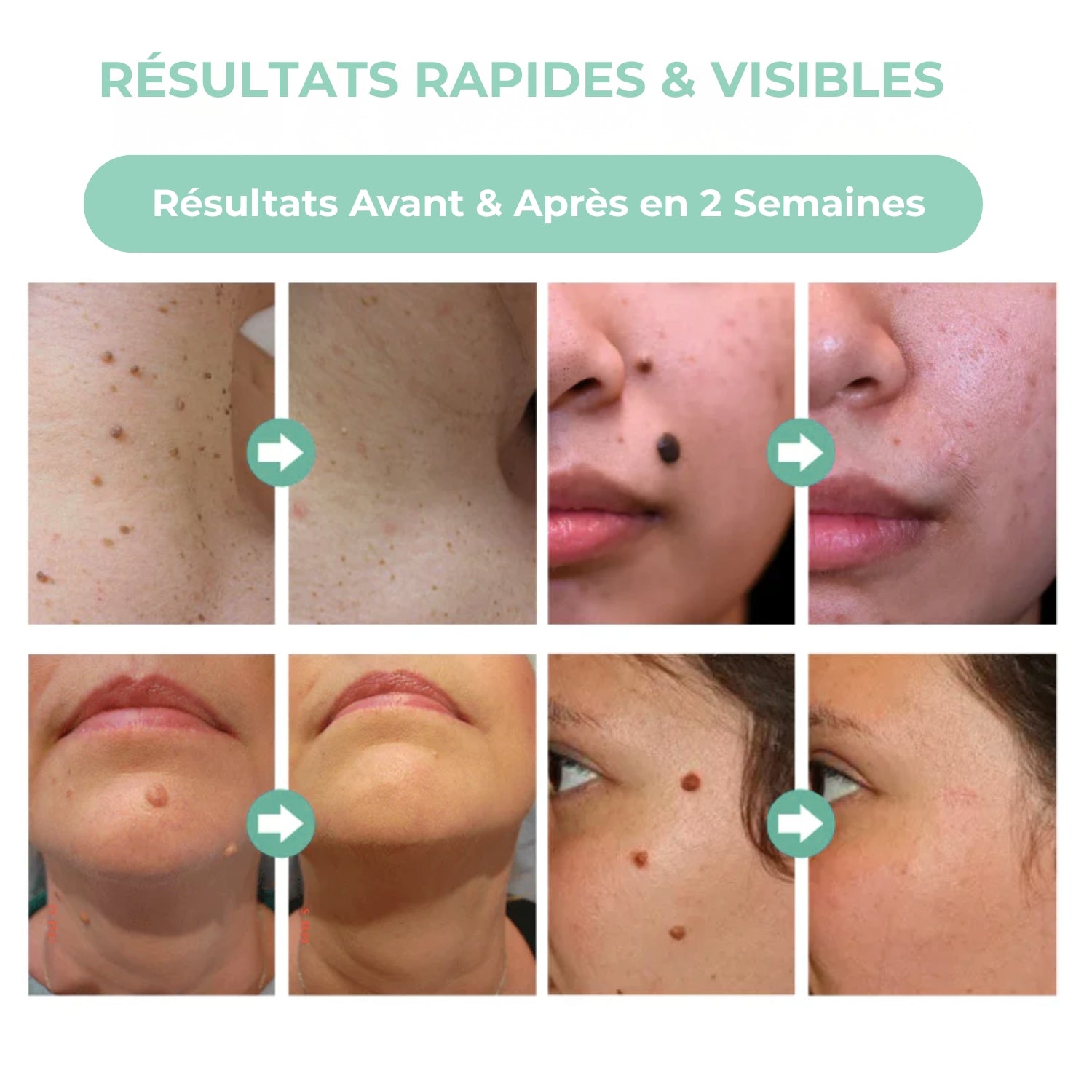 Nuvare | Élimination des grains de beauté, verrues & acrochordons